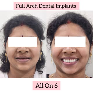 When teeth look fine but aren’t functional…

This is a case of chronic generalized periodontitis led