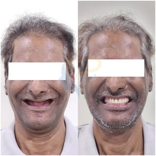 Loaded & Delivered Fixed Temporary Teeth in 7 Days, Surgery to Supper within a week ! 🍽️✨

All-on-6