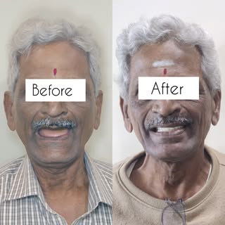 Surgery to a confident smile in 48 hours. 

A patient-specific titanium implant in the upper jaw com