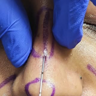 Full Face Fillers & Botox but clients says no face reveal in video 😅 #filler #botox #hyderabad #aes
