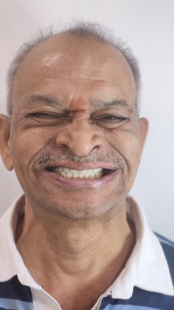 All On X - Full Mouth Implant rehabilitation case done by @dr.deepakpusa using @jdentalcare dental i