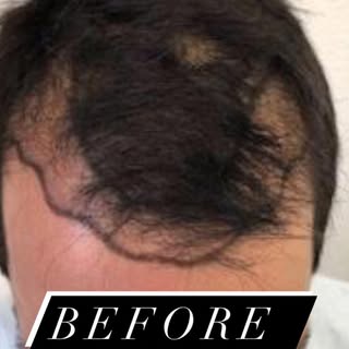 Swipe left to view before & after photos of one of our satisfied patient’s results! 10 months #posts