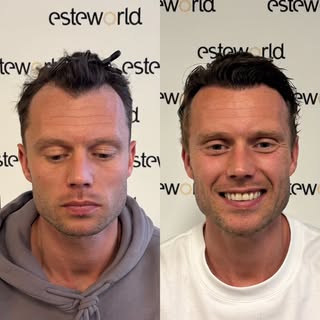 2000 grafts met vollige focus op de voorste haarlijn voor Bram.
Getransplanteeed met een soft densit
