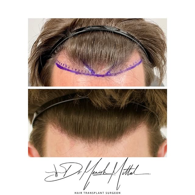 Pleased to share some of our patients close up images of a 2000 graft hair restoration 12 months pos