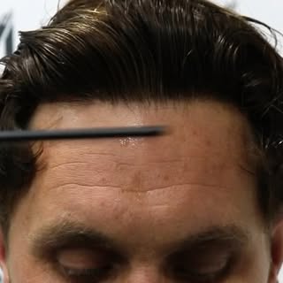 CASE STUDY | 12 MONTHS POST OP

Not all hair transplants are created equal.

“Doc I don’t use produc