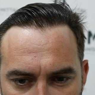 Wet hair hides nothing. And that’s exactly why I’m showing you this.

No fibres. No clever styling. 