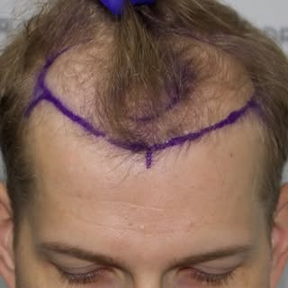 “He looks like Matthew McConaughey now.” 😂

I’ll let you decide…

This is 2,300 grafts on ultra-fin