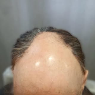 A ALOPECIA FIBROSANTE FRONTAL pode mudar a imagem, mas não precisa de mudar a forma como se sente.

