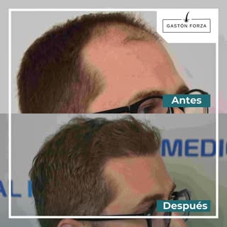 Paciente con diagnóstico de alopecia con un antes y después a 18 meses de la intervención, momento e
