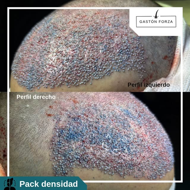 🔬Caso de paciente en el que decidimos utilizar pack de densidad para reconstrucción frontal y de án