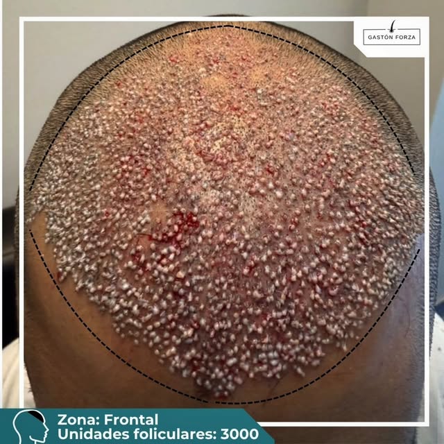 🔬El caso de hoy se trata de una reconstrucción frontal en un paciente con alopecia grado IV-A.

Rea