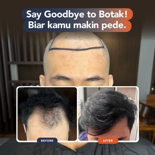 Don’t let baldness ruin your confidence! Get your self -confidence back again only at @beyoutifulhai