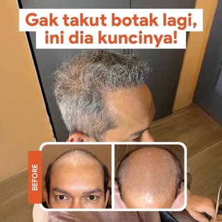 Life isn’t perfect, but your hair can be perfect only at @beyoutifulhairtransplantcenter