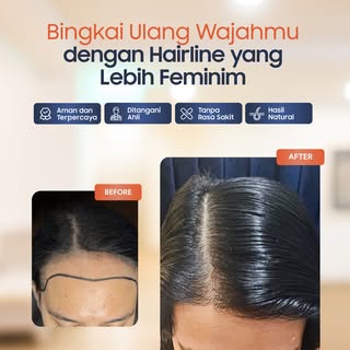 Redefine your features with a soft, feminine hairline! ✨

Lewat transplantasi rambut yang presisi, b