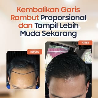 Ngerasa garis rambut semakin mundur dan bikin kelihatan lebih tua dari umur aslinya?  It’s time to b