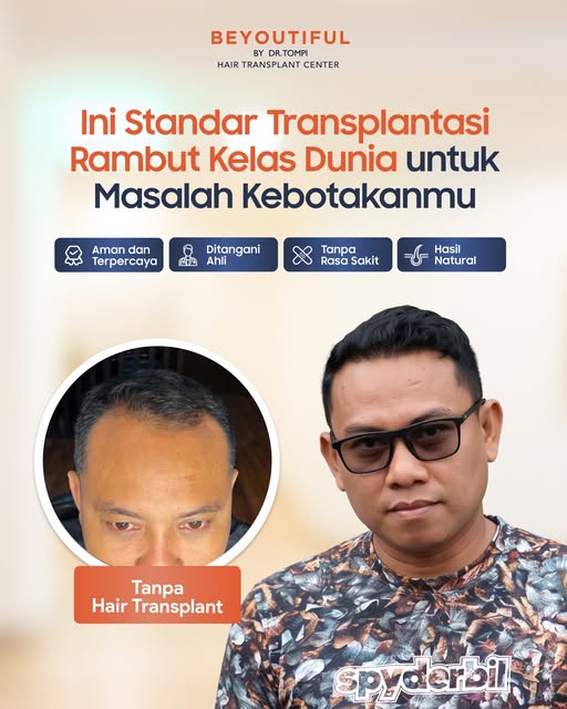 Masih ragu atau coba-coba solusi kebotakan yang belum pasti? It’s time to choose standard & proven r
