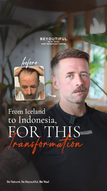 From hair loss concerns to a result he feels confident with.

Hear @gunnareysteinsson ’s experience 