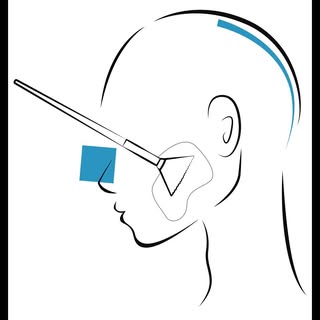 Le peeling phénol est une technique de régénération cutanée en profondeur qui stimule le renouvellem