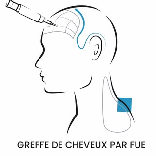 Une greffe capillaire réussie, c’est avant tout un travail d’équipe 💪👥

La technique FUE (Follicul