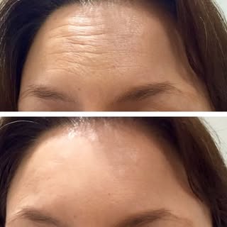 Now reduce your fine lines and wrinkles with just one session ✨
.
.
.
.
.
.
#botox #beauty #fillers 