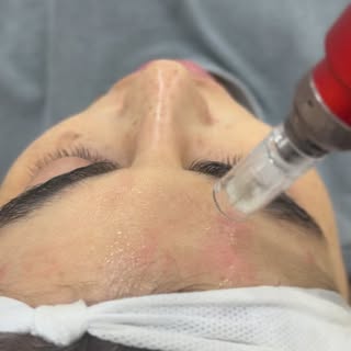 Transform your skin from the inside out with the magic of microneedling.

#Microneedling
#SkinRejuve