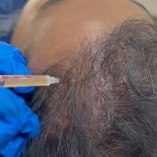 Hair restoration advance hair prp 

#prptreatment #hairprp #hairprptherapy #hairprptreatment #gfc #h