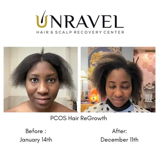 PCOS Hair ReGrowth! With patience and dedication your hair can regrow better than ever!!!
.
.
.
.
.
