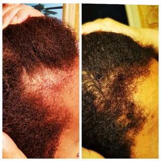 Before & After using our Itch Relief Growth Oil! 

Are you suffering from a dry, itchy, or flaky sca