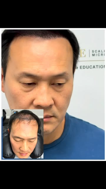NO, YOU DO NOT HAVE TO CUT OR SHAVE YOUR HAIR IN ORDER TO GET SMP! 
.
With a proper experience and t