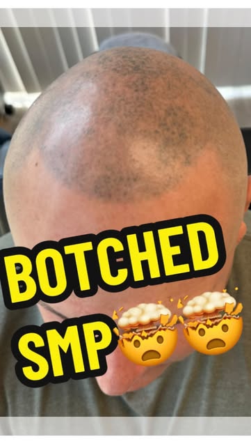 Unfortunately Another SMP correction😬😬

This client originally went to a tattoo artist for his SMP