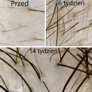 Widzisz prześwity? To może być już ostatni dzwonek

Łysienie androgenowe nie dzieje się z dnia na dz