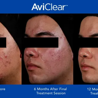 Aviclear