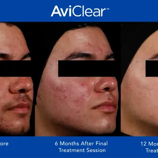 Aciclear