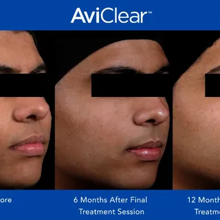 Aviclear