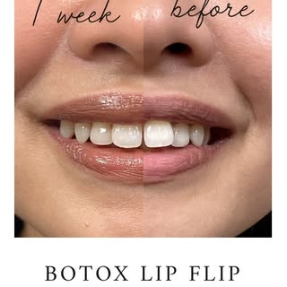 Enhance your lips with #Botox. Subtle, natural lift and fullness. The #lipflip also helps to correct
