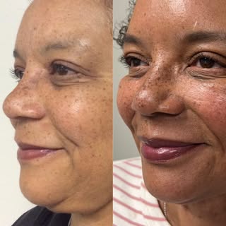 Natural Enhancement with Anti-wrinkle Injections 💉🪄✨

#botox #antiwrinkle #filler #fillers #skinca