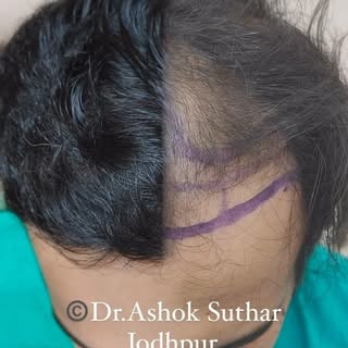 Hair Transplant  surgery results before and after 7 months for more contact Dr.Ashok Suthar Jodhpur 