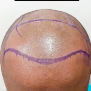 6-Month Hair Transplant Result | Natural Growth. Progressive Density.

A successful hair transplant 