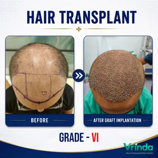 HAIR TRANSPLANT | PRECISION FROM THE VERY FIRST STEP ✨

A hair transplant is not just about placing 