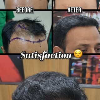 Hair Transplant Transformation ✨

A natural-looking hairline. Better density. More confidence.

Ever