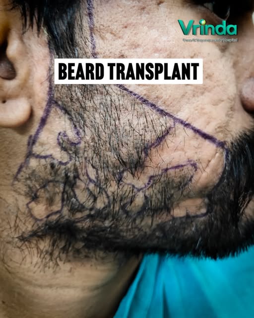 🧔 BEARD TRANSPLANT 

The journey starts here… 👀
Wait 6 months… and see the result! 🔥 

Natural gr