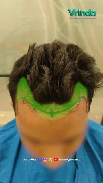 Hair Transplant Surgery Successfully Completed ✨

A new hair restoration journey begins today.
With 