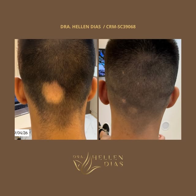 Alopecia Areata - 4 meses de tratamento! 

Este paciente me procurou devido à presença de falhas arr