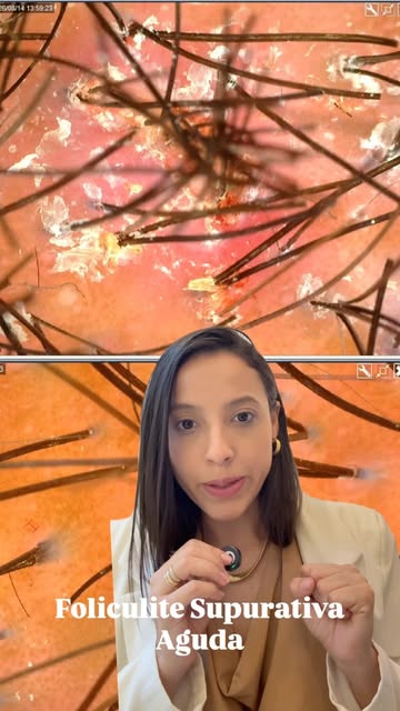 Foliculite supurativa aguda. 

#foliculite #foliculitecapilar #tricologiacapilar
