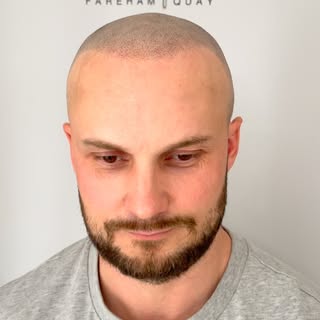 Is your hair loss affecting you? 🤔 

Are you lacking confidence due to your hair loss? 🙂‍↕️

Let m