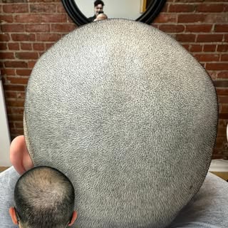 CUL-DE-SAC REMOVAL💥
• HEALED vs FRESH SMP •
>>>SWIPE to see what our healed SMP looked fresh during