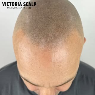 HEALED SMP • 1 YEAR OLD 
👉🏼👉🏼👉🏼SWIPE to see MORE of the journey

•Morph clip from before to 1 