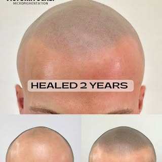 HEALED SMP • 2 YEARS OLD 
👉🏼👉🏼👉🏼SWIPE to see larger images

My SMP client from 2 years ago cam