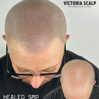 HEALED SMP • 1 YEAR OLD 
👉🏼👉🏼👉🏼SWIPE to see larger images 
▪️Healed (Now). 
▪️Fresh 3rd Sessio