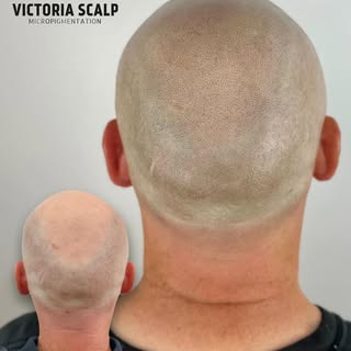 💥CUL-DE-SAC REMOVAL 💥
•third session results•
>>>SWIPE for ZOOMables

Norwood 7 hair loss CRUSHED.